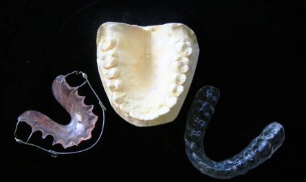 12 Significados de Soñar con Aparatos de Ortodoncia