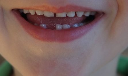 9 Significados de Soñar con Dientes Perdidos