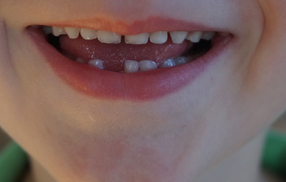 9 Significados de Soñar con Dientes Perdidos