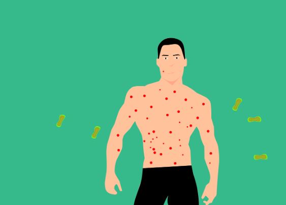 ¿Qué significa soñar con varicela?