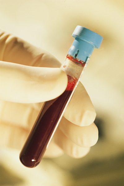 為什麼醫生要監測LDL和 HDL？