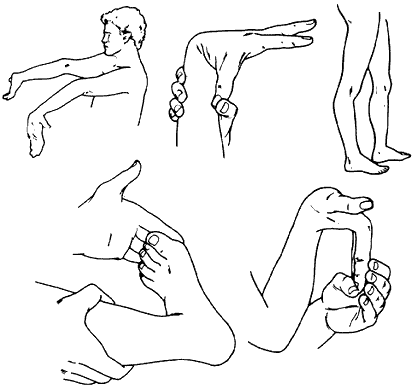 什麼是 Ehlers-Danlos 綜合征？